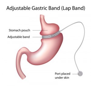 12176783_s.jpg  gastric lap band image